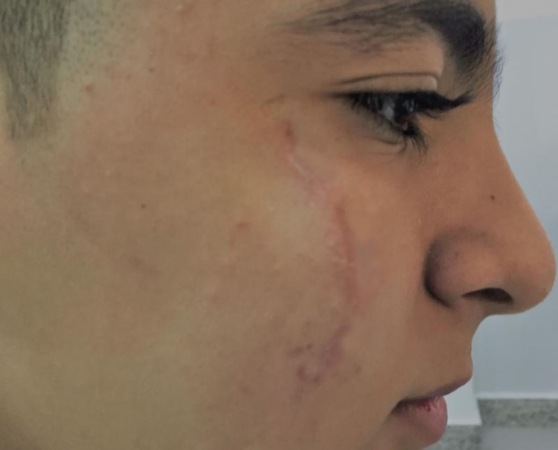 Erbium Laser, Fractional Laser, Co2 Laser, Best Plastic surgery, Cosmetic Laser