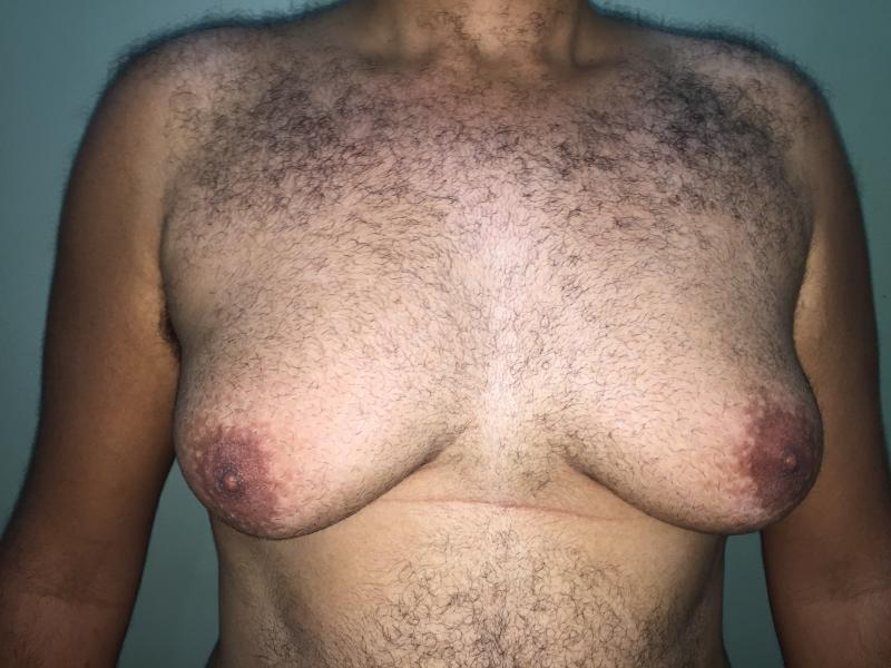 Gynecomastia Egypt, Male Breast Reduction, Best Cosmetic Aesthetic Surgery Egypt