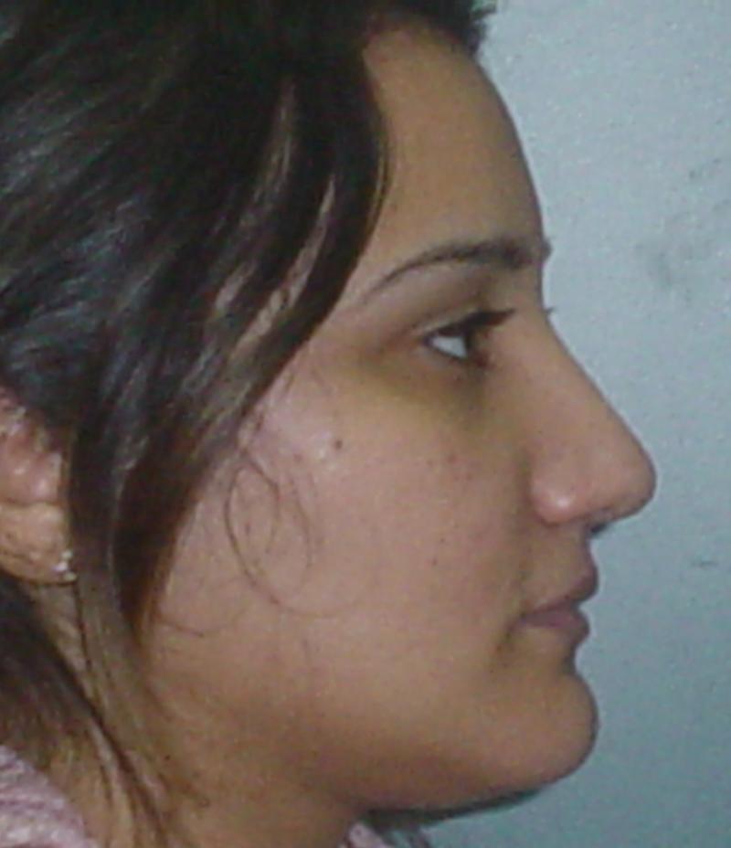 Cairo Nose job Egypt Plastic Surgery Saddle nose cartilage dorsum hump tip boxy