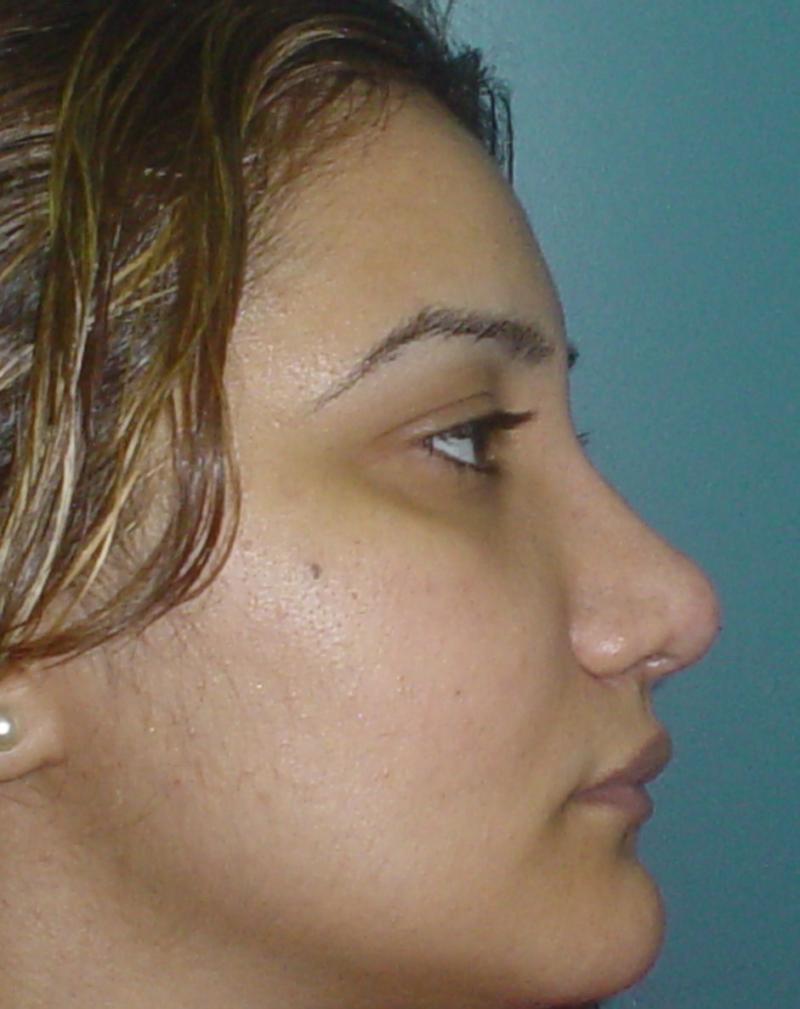 Nose job Egypt Plastic Surgery deformity nose cartilage dorsum hump tip boxy