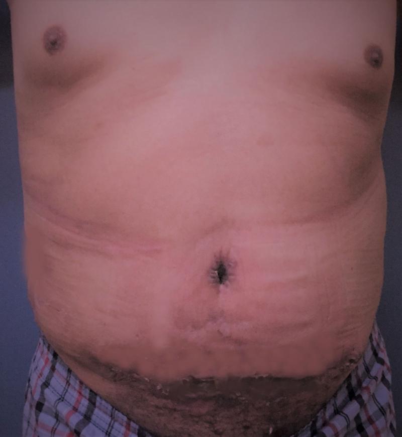 شد البطن تنسيق القوام افضل جراحة تجميل Abdominoplasty, Tummy Tuck, Vaser Liposuc