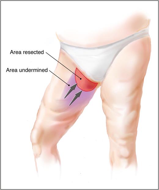 Thigh lift, Thigh Liposuction, Medial thigh lift, Obesity, Best Cosmetic Surgery