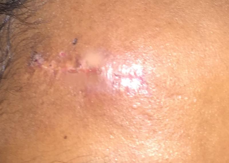 Fat Injection, Fat Grafting, Scars, Face lift, Stem cells, Best Plastic Surgery