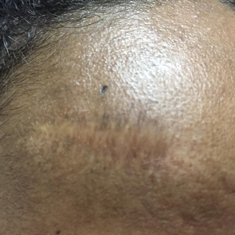 Fat Injection, Fat Grafting, Scars, Face lift, Stem cells, Best Cosmetic Surgery