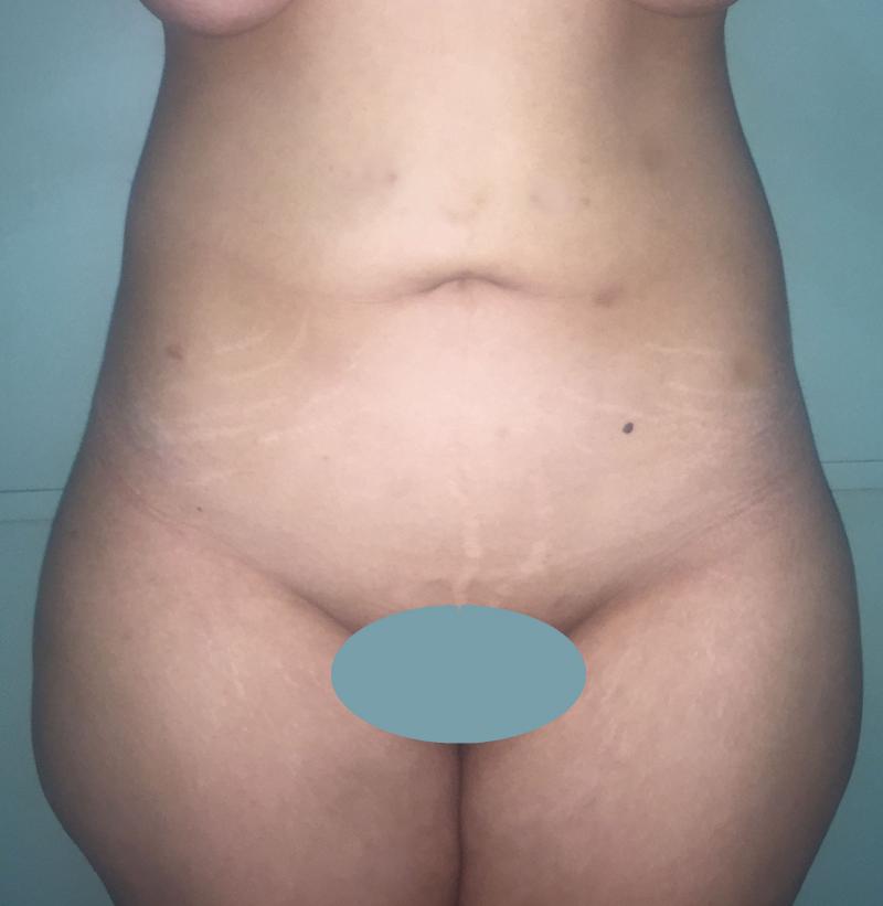 Body Lift, arm Lift, Thigh Laser Liposuction, Sleeve Gastrectomy, Cosmetic Surge