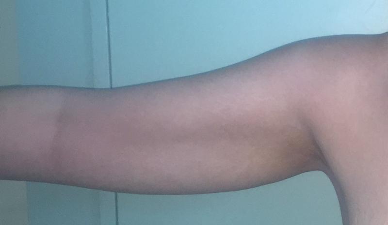 Arm Lift, Arm Liposuction, Arm Laser Liposuction, Sleeve Gastrectomy, Cosmetic 