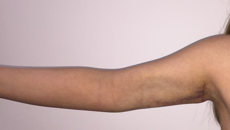 Arm Lift, Arm Liposuction, Arm Vaser Liposuction, Sleeve Gastrectomy, Cosmetic