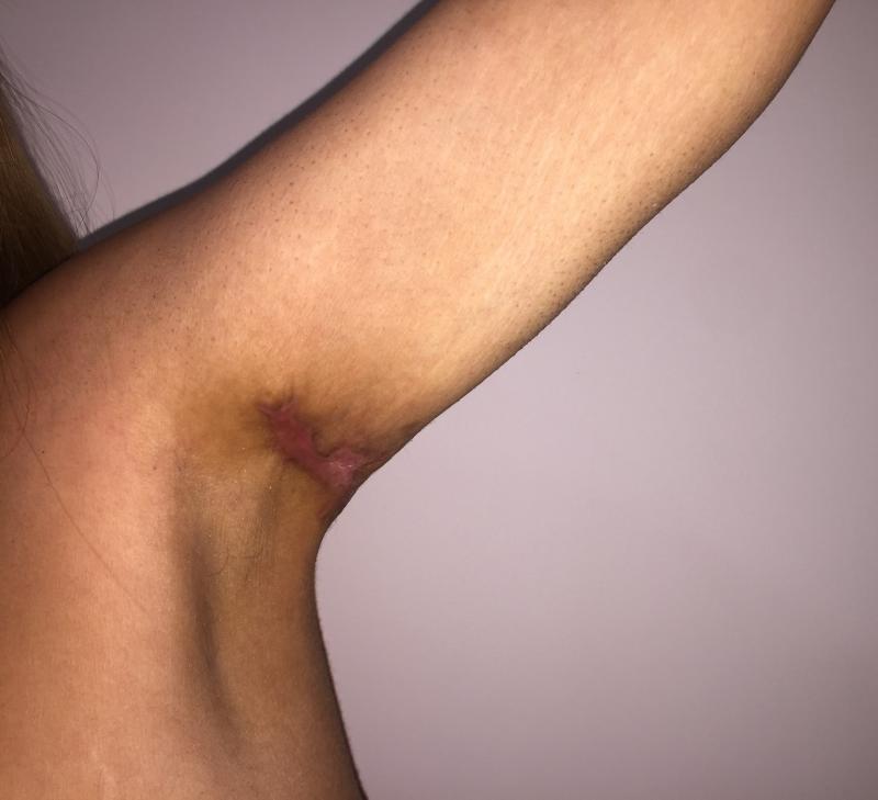 Arm Lift, Arm Liposuction, Arm Vaser Liposuction, Bariatric Surgery, Cosmetic Su