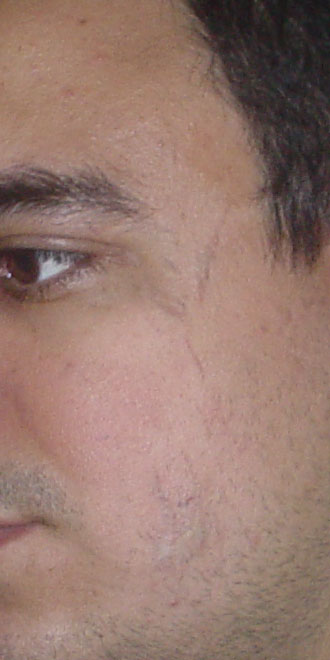 Plastic Surgery Egypt,Cosmetic Surgery Egypt, Scar, laser removal, Nd-YAG Laser