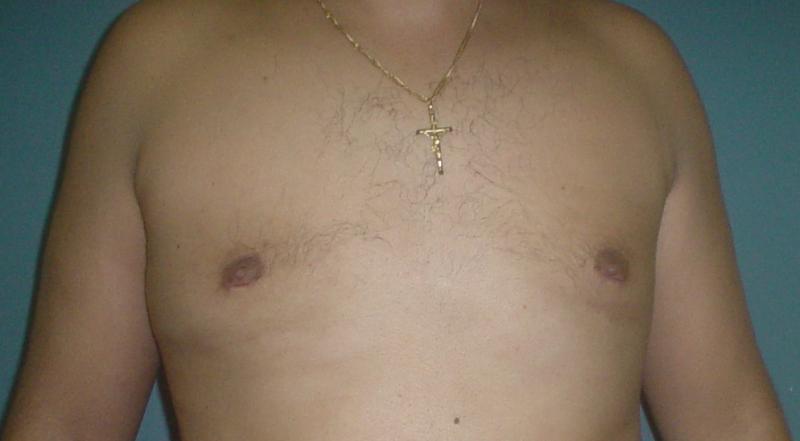 Gynecomastia,male breast reduction,laser liposuction,cosmetic surgery,egypt,cair