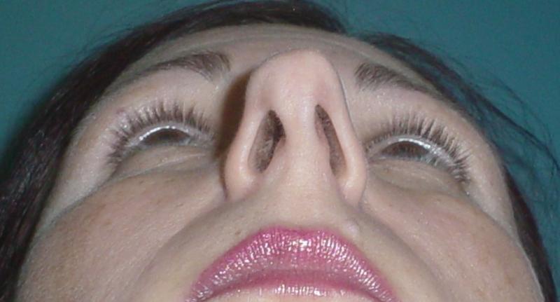 Plast surgery,egypt,nose job,tip,hump,cairo,rhinoplasty,eyelid,breast,liposuctio