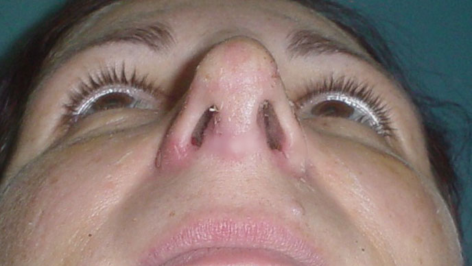 cosmetic surgery,egypt,rhinoplasty,tip definition,hump,liposuction,breast reduc