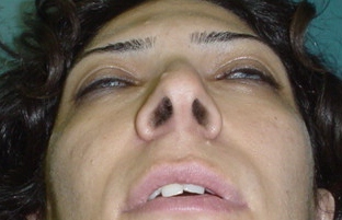 Cosmetic Surgery in Egypt, Nose job,tip deformity,wide tip,Plastic Surgery Egypt