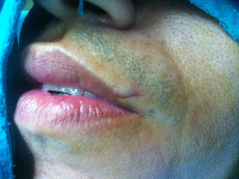 Cosmetic Surgery Egypt, Aesthetic Surgery, Lip surgery, Lip Scar, Stem Cells