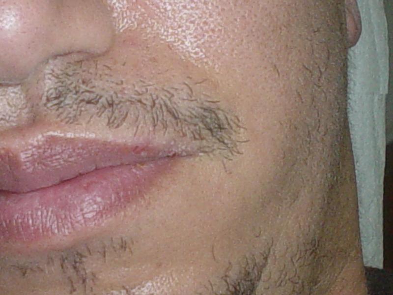 Plastic Surgery Egypt, Aesthetic Surgery, Lip surgery, Lip Scar, Stem Cells