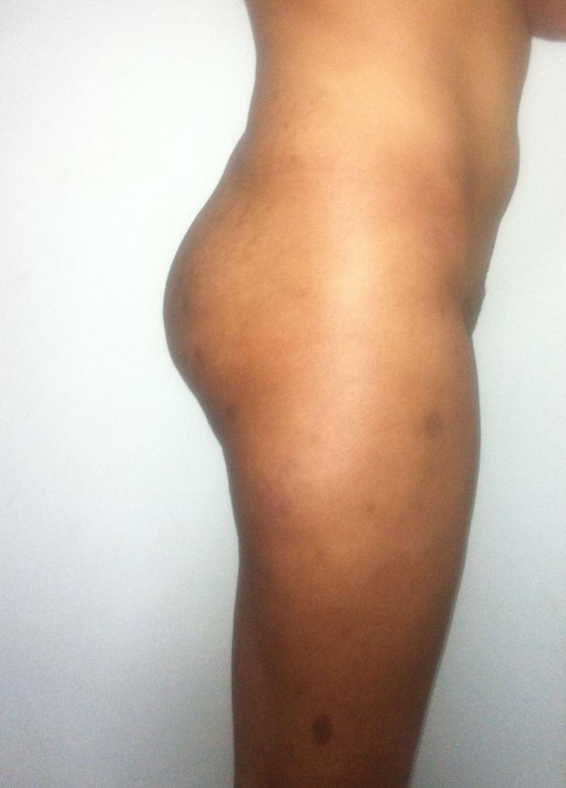 Best Cosmetic Surgery Egypt, Butt Implants, Butt Augmentaion, Fat Injection