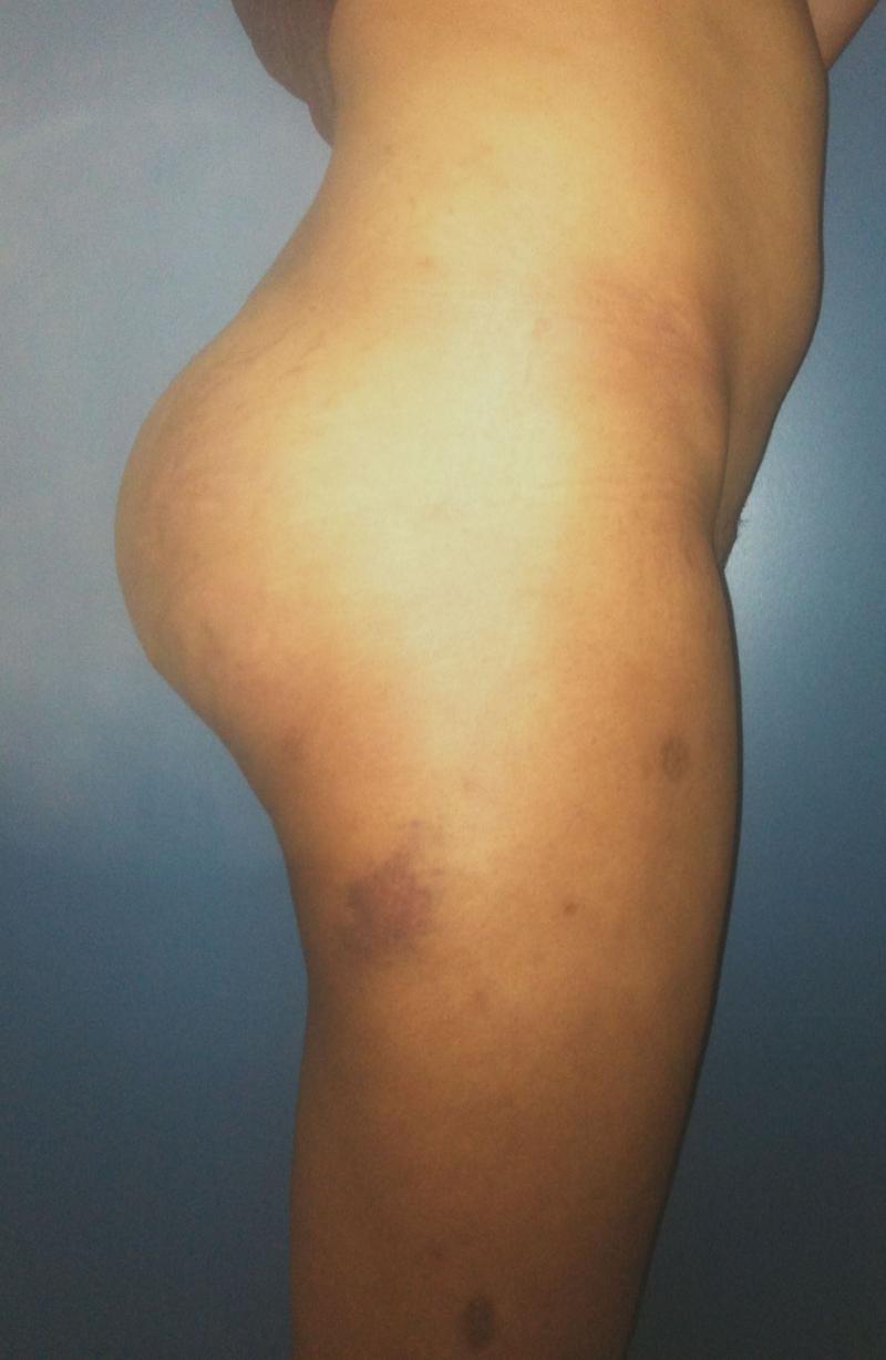 Best Plastic Surgery Egypt, Butt Implants, Butt Augmentaion, Fat Injection