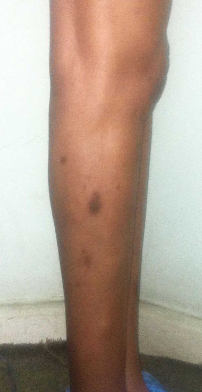 Leg augmentation, Calf enlargement Egypt, Silicon Implants , Cosmetic Surgery 