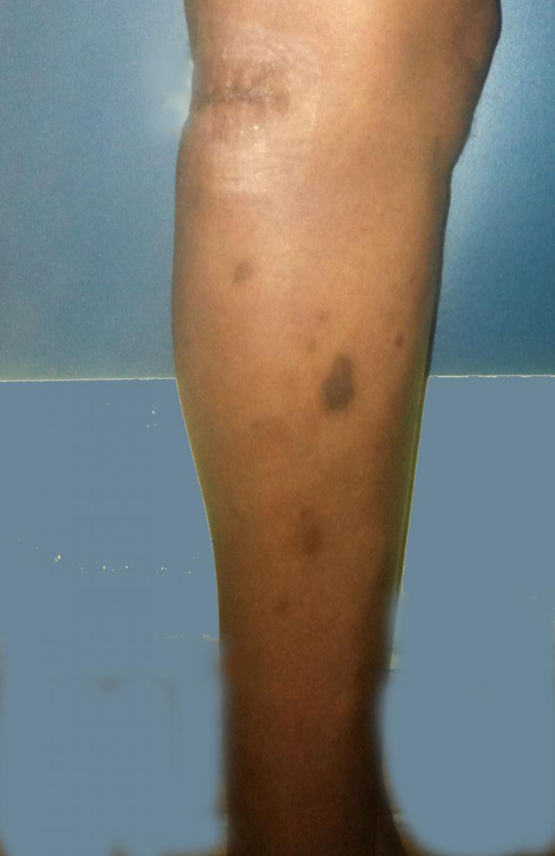 Leg augmentation, Calf enlargement Egypt, Silicon Implants , Plastic Surgery
