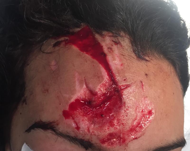 Best Plastic Surgery Egypt, Scars, Botox Injection, Fat Injection, Keloids