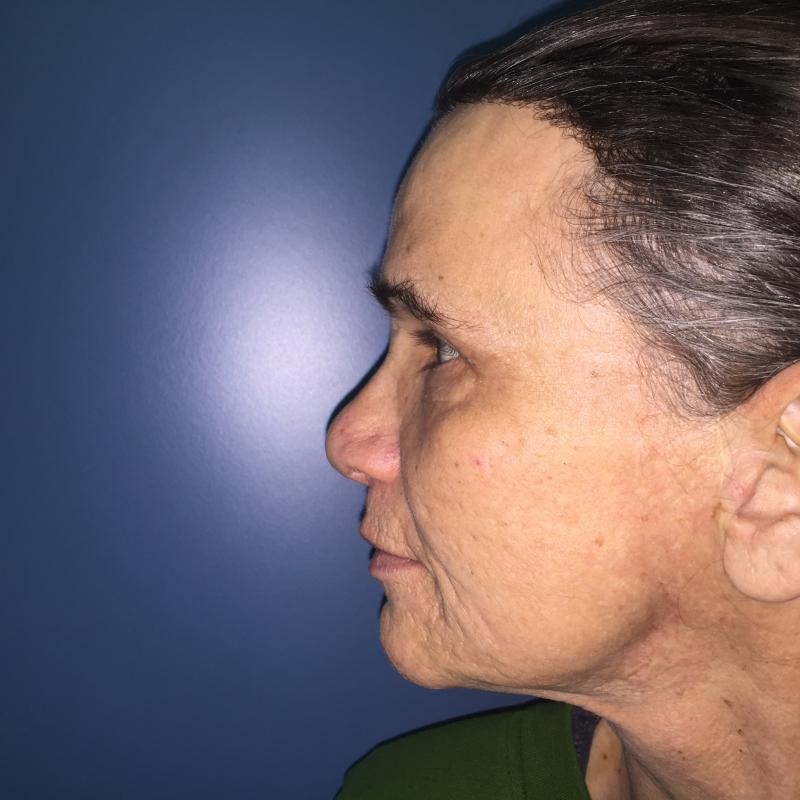 Forehead Reduction, Forehead Lift, Endotyne, Face Lift, Best Plastic Surgery 