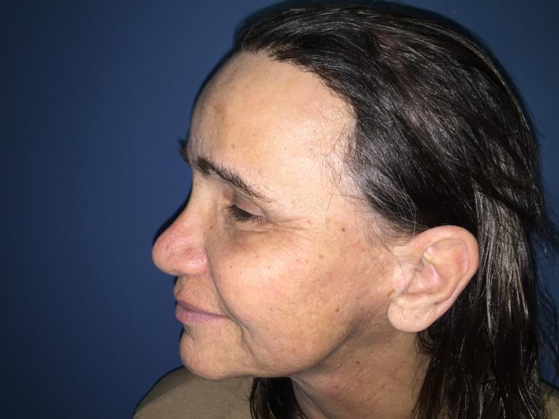 Forehead Reduction, Forehead Lift, Endotyne, Face Lift, Best Cosmetic Surgery