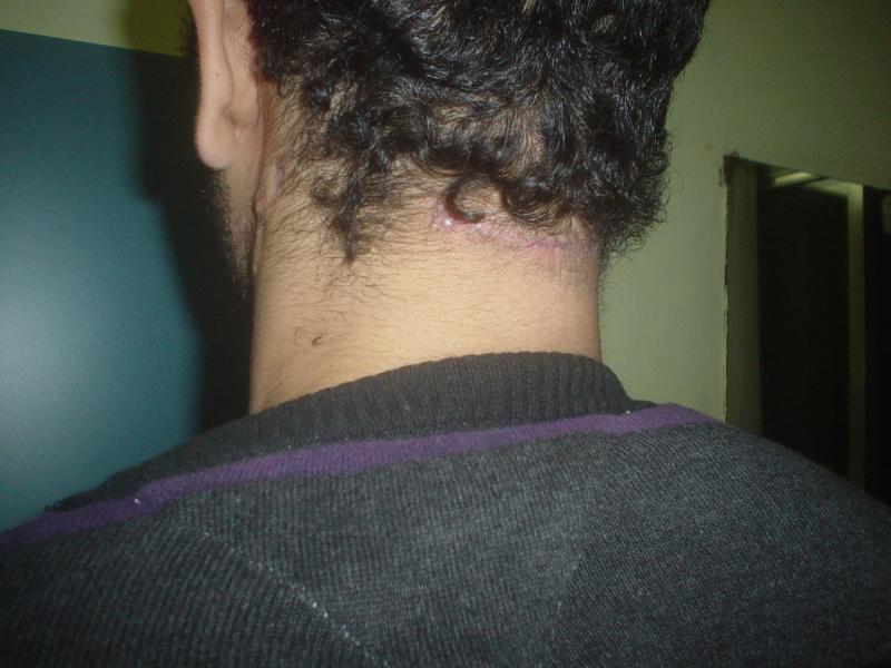 Scars in Egypt, Botox in Egypt, Best Cosmetic Surgeon in Egypt, Face Lift