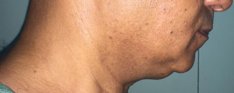 Neck Lift, Neck liposuction, neck bands, Laser Liposuction, Best Cosmetic
