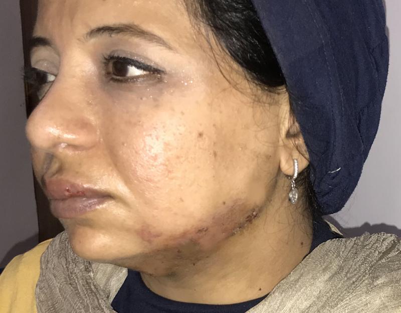 Best Plastic Surgery in Egypt for Face Lift and Neck Hemangioma Cosmetic Lift
