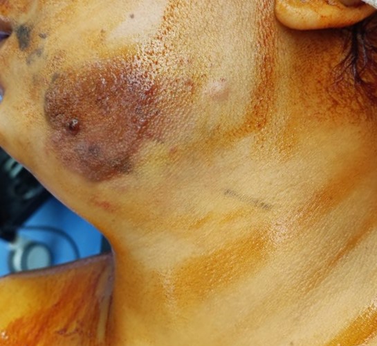 Best Plastic Surgery in Egypt for Face Hamangioma and Neck Lift Cosmetic