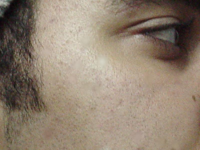 Fractional Laser Cairo Cosmetic plastic surgery  scar spots skin tags pigment