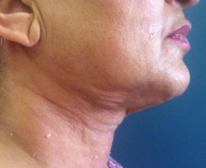 Best Cosmetic Surgery Egypt, Neck Lift, Lip Fillers, Face Lift, Neck laser Lipo