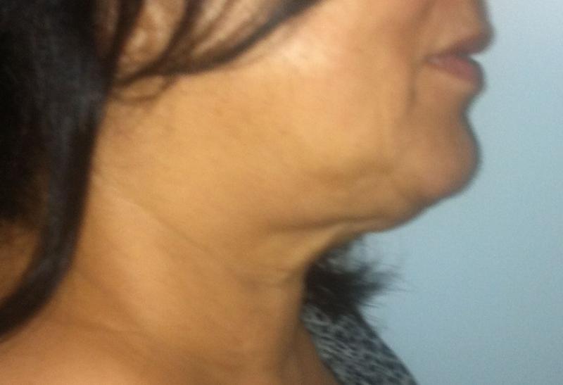 Best Plastic Surgery Egypt, Neck Lift, Lip Fillers, Face Lift, Neck laser Lipo