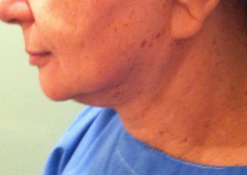 Neck Lift Egypt, Laser Liposuction, Vaser Liposuction, Face Lift, Eyelid Surgery