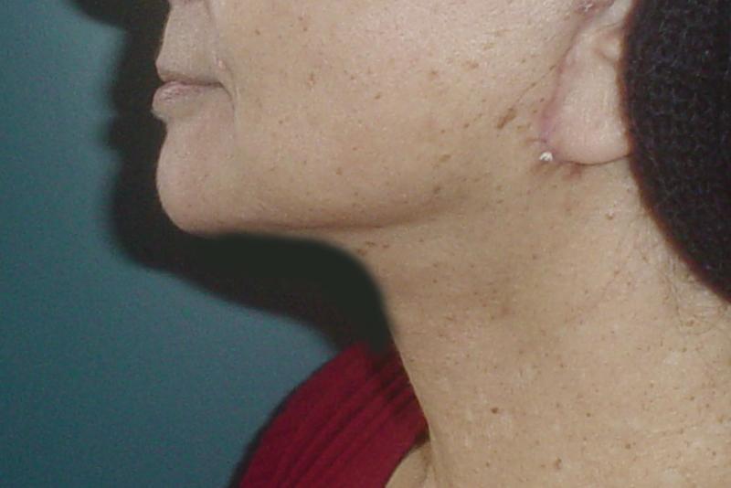 Neck Lift Egypt, Laser Liposuction, Vaser Liposuction, Face Lift, Cosmeti Surger