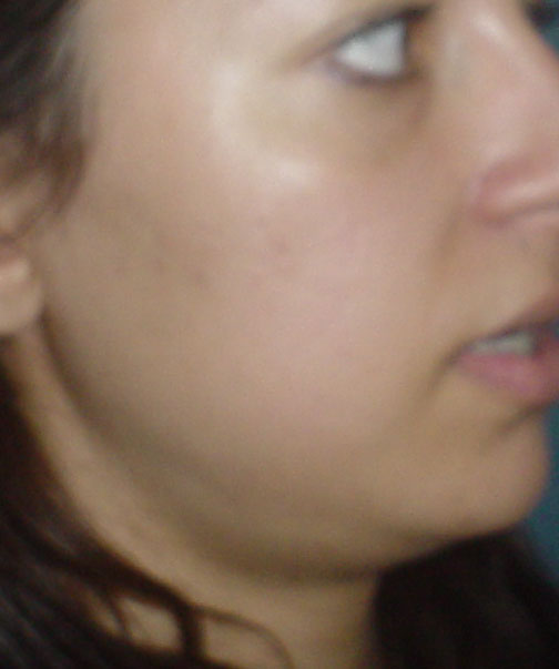 Cosmetic Surgery Egypt, Lipolysis, Neck lift, Face lift, sculpturing, Jaw-line