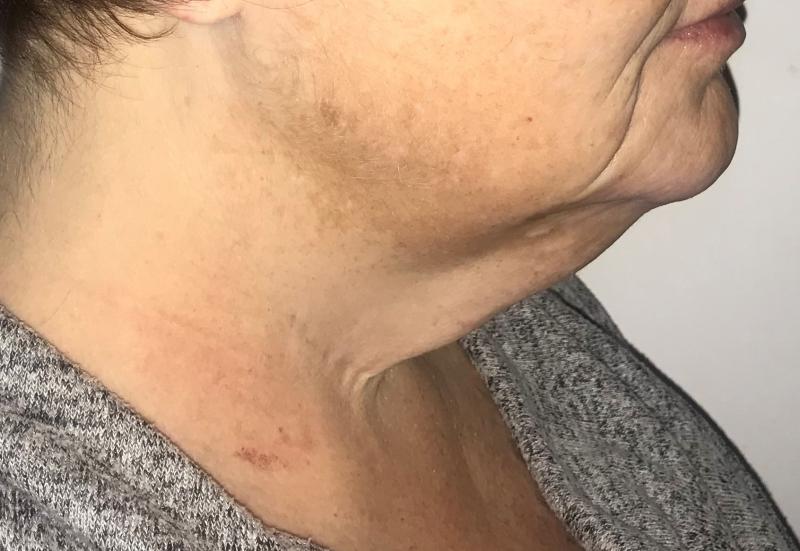 Neck Lift, Platyzmal band, Vaser Neck Lipo, Best Esthetc Surgery, Jowls, jawline