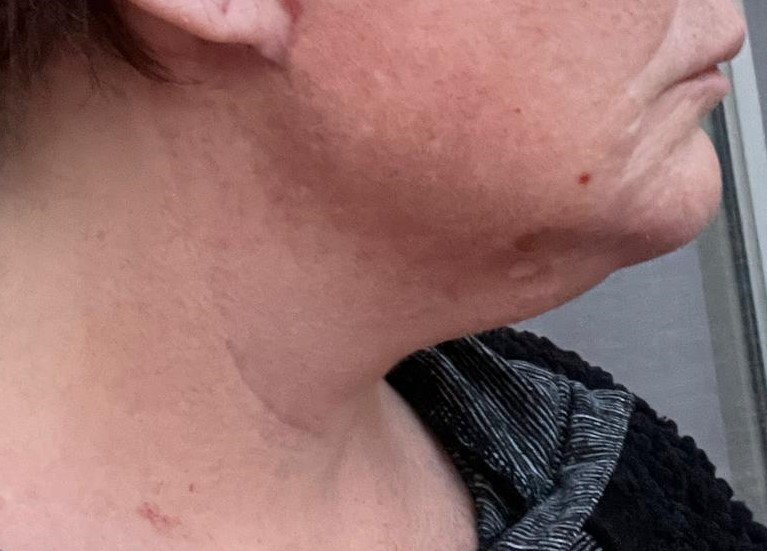 Neck Lift, Platyzmal band, Laser Neck Lipo, Best cosmetic Surgery, Jowls, jawlin