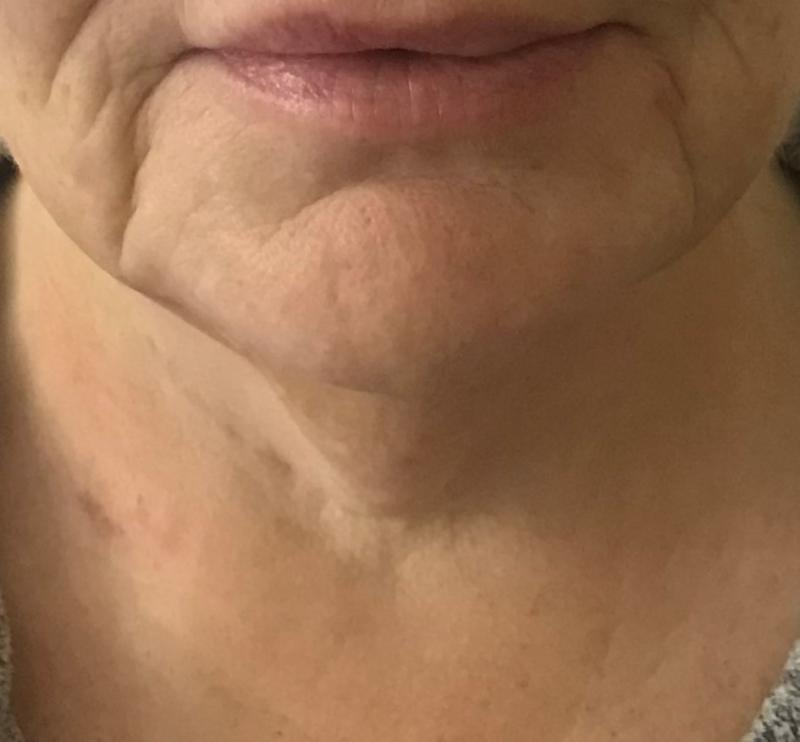 Neck Lift, Platyzmal band, Vaser Neck Lipo, Best cosmetic Surgery, Jowls, jawlin