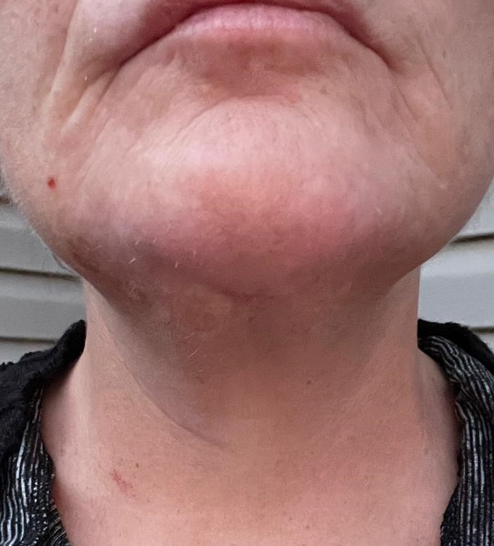 Neck Lift, Platyzmal band, Vaser Neck Lipo, Best Plastic Surgery, Jowls, jawline