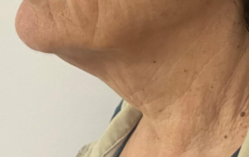 Lax neck skin and Neck fat treated by Neck Liposuction Lift at Best Plastic Surg