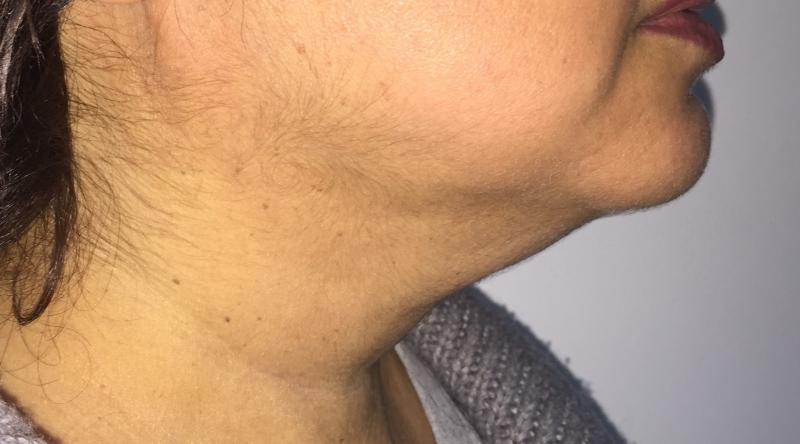 Neck Lift Neck Vaser Lipo, Neck Threads, Vaser Liposuction, Best Cosmetic Surger