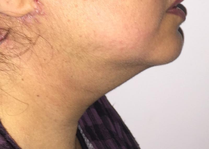 Neck Lift Neck Vaser Lipo, Neck Threads, Vaser Liposuction, Best Plastic Surgery