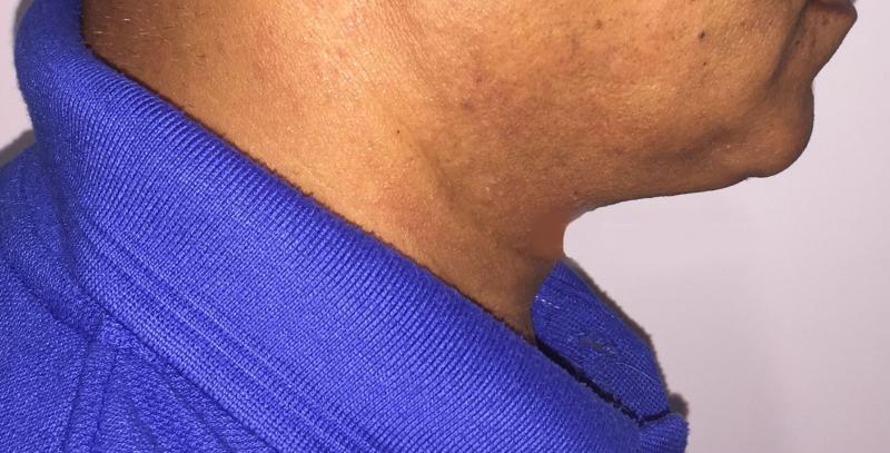 Neck Lift, Neck Liposuction, Vaser Neck Lipo, Best cosmetic Surgery, Lax neck
