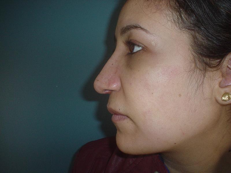 Best Cosmetic Surgeon Egypt, Nose Hump Egypt, Nose tip Egypt, Rhinoplasty Egypt