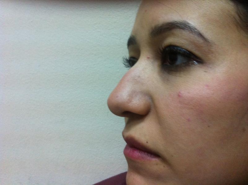 Best Plastic Surgeon Egypt, Nose Hump Egypt, Nose tip Egypt, Rhinoplasty Egypt