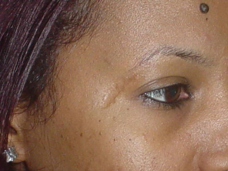 Plastic Surgery Egypt, Face Scars, Stem Cells, Eyebrow scars, Fat transplantatio