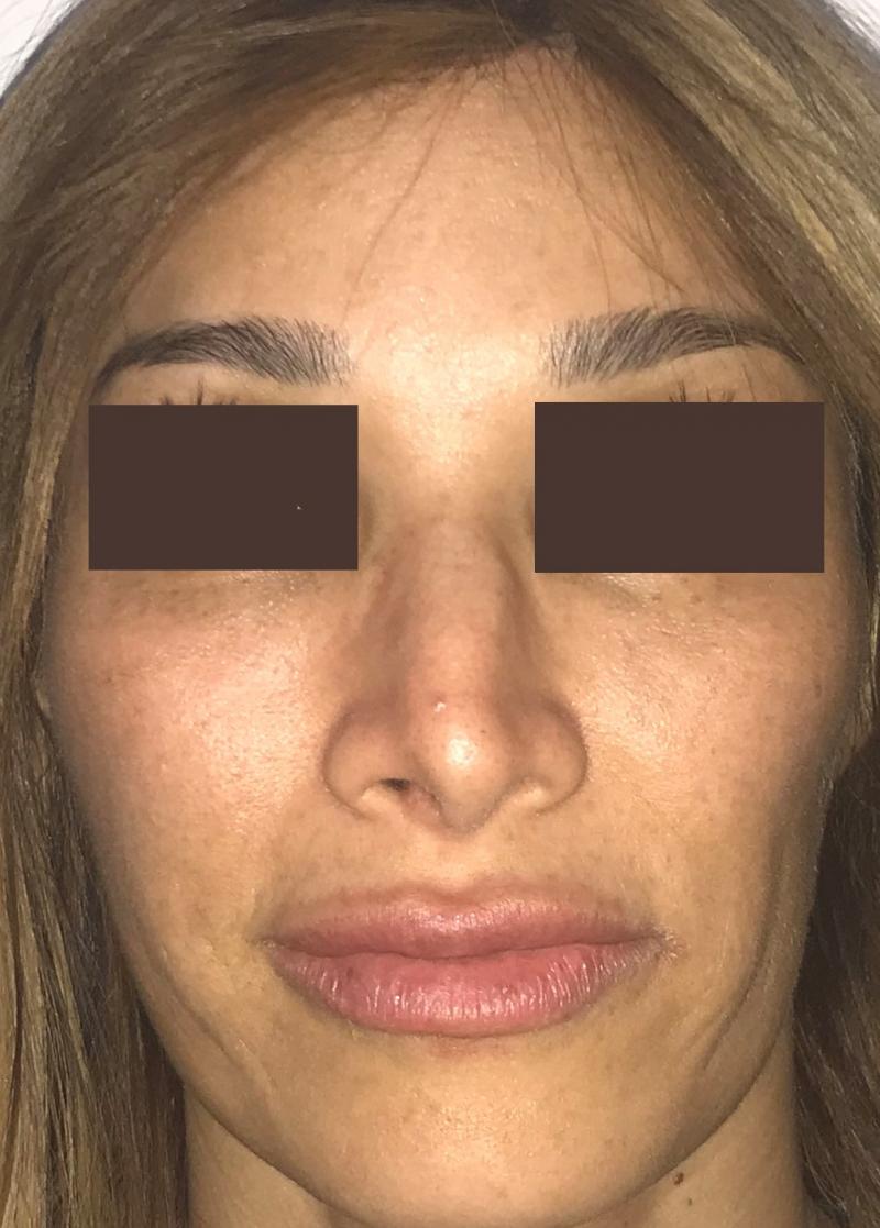 Nose job, Rhinoplasty, Tip definition, Tip elevation, Dorsal Hump, Best cosmetic