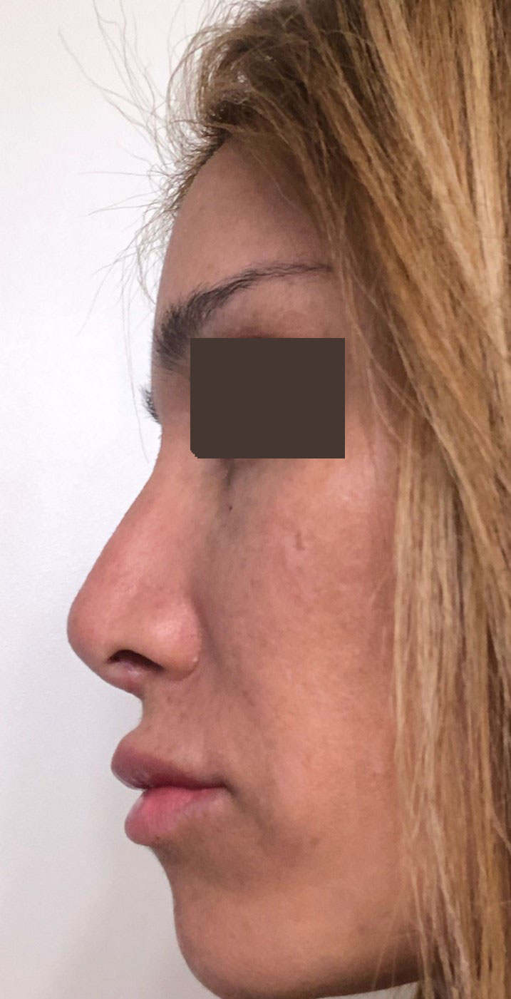 Nose job, Rhinoplasty, Tip definition, Tip elevation, Dorsal Hump, Symmetry nose