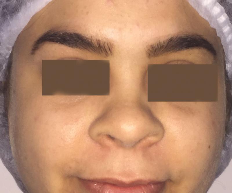 Open rhinoplasty, Open Nose Job, Wide alae Nasi, Nose Tip, Cosmetic Surgery